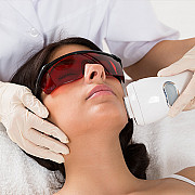 Tratament laser pentru pete pigmentare