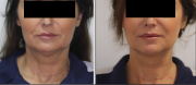 Face lift "Nefertiti" prin metoda 3D HIFU SMAS-Ultrasunetele focusate
