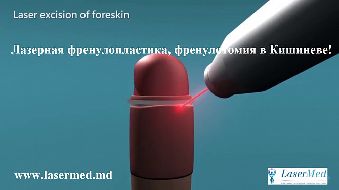 Лазерная френулопластика в Молдове (Кишиневе)! - изображение 1