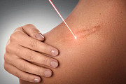 Tratament cu laser pentru indepartarea si eliminarea, (corectia) cica