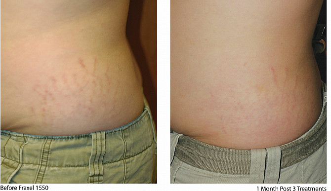 Tratamentul vergeturilor cu laser fractional in Moldova! - imagine 1