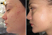 Remodelarea cutanata cu laser (laser skin resurfacing) in Chisinau!