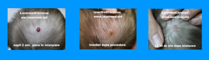 Tratamentul hemangioamelor cu Laser (Înlăturarea hemangiom cu laser) i - imagine 1