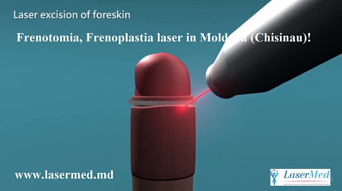 Frenotomia, Frenoplastia laser in Moldova (Chisinau)! - изображение 1