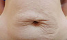 Tratamentul vergeturilor cu laser fractional in Moldova!