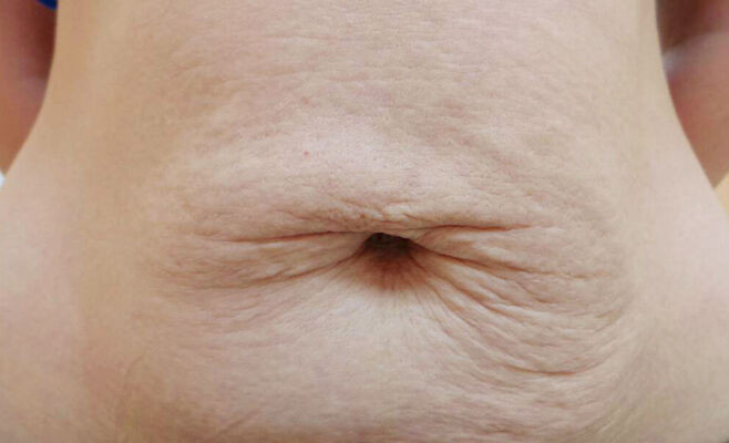 Tratamentul vergeturilor cu laser fractional in Moldova! - imagine 1