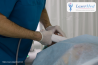Remodelarea cutanata cu laser (peeling-ul cu laser, lasabraziune, resu