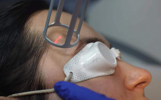 Rejuvenare cu laser a pleoapelor in Moldova (Chisinau)! - imagine 1