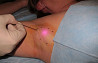 Tratamentul cu laser a hiperhidrozei axilare in Moldova!
