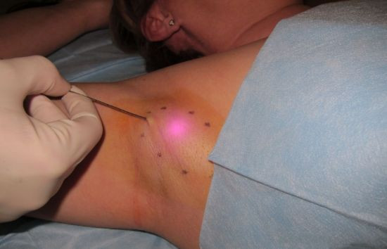 Tratamentul cu laser a hiperhidrozei axilare in Moldova! - изображение 1