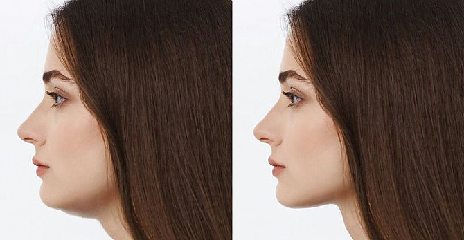 Remodelare corporala prin lipoliza asistata laser in Moldova! - imagine 1