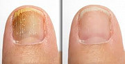 Tratament laser a onicomicozei (Infectia fungica a unghiei, micoza ung