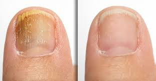 Tratament laser a onicomicozei (Infectia fungica a unghiei, micoza ung - imagine 1