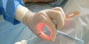Tratament laser a fisurii anale in Moldova, Chisinau!