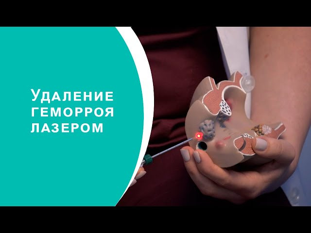 Лазерное удаление геморроя в Молдове, Кишиневе! - imagine 1