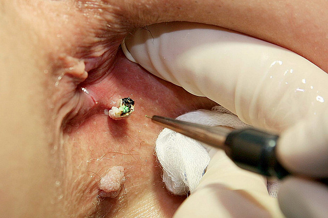 Tratament laser pentru vegetatiile veneriene (condiloamele, condyloma - imagine 1
