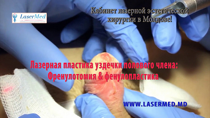 Лазерная френулопластика, френулотомия в Кишиневе! - imagine 1
